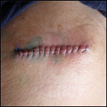 Stitches of a victim
