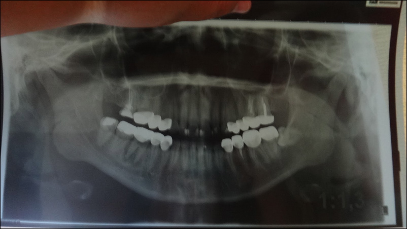 Teeth scan X-ray
